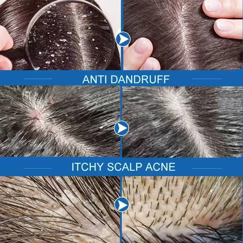 빠른 비듬 방지 헤어 트리트먼트 비누 가려움증 수리 두 - Hair Care Dandruff 리뷰 및 가격